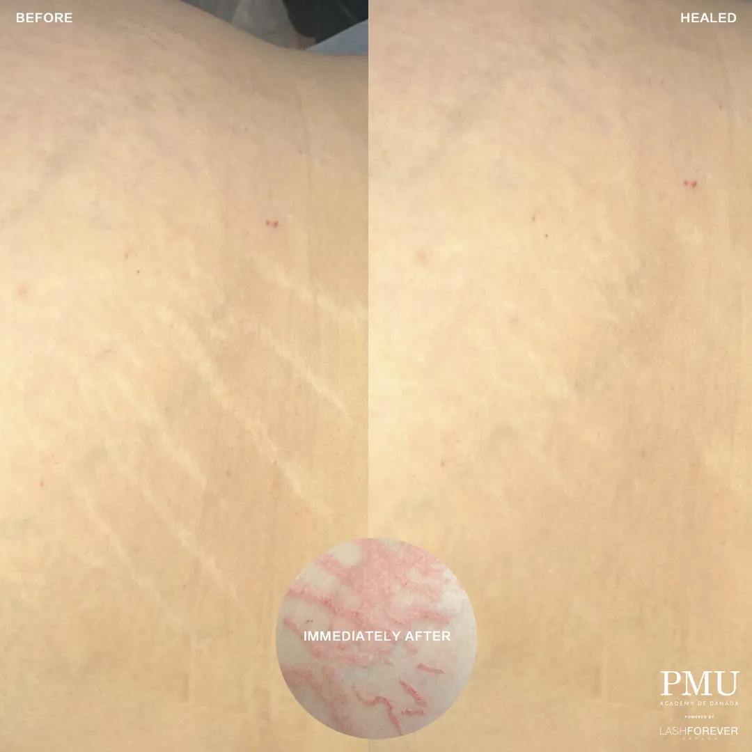 HDi Scar & Stretch Mark Camouflage Course Deposit