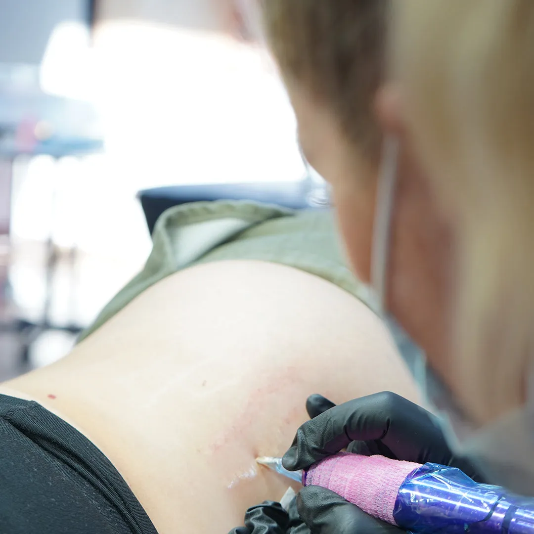 HDi Scar & Stretch Mark Camouflage Course Deposit