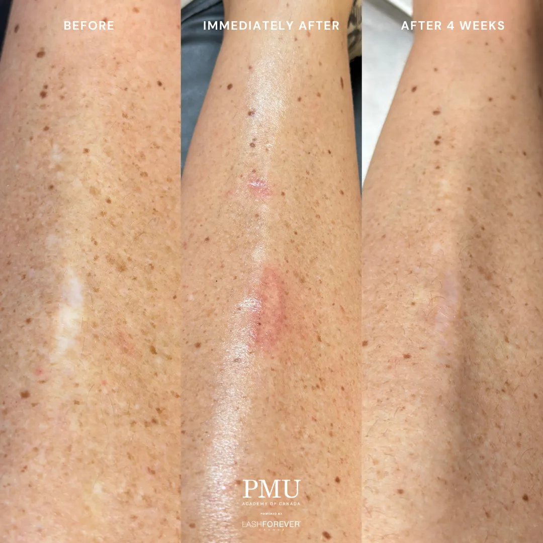 HDi Scar & Stretch Mark Camouflage Course Deposit